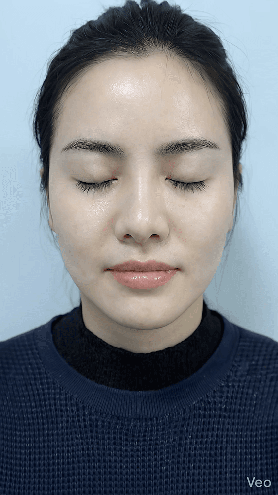 Hình minh họa tình trạng da sau liệu trình phục hồi tại ARIN