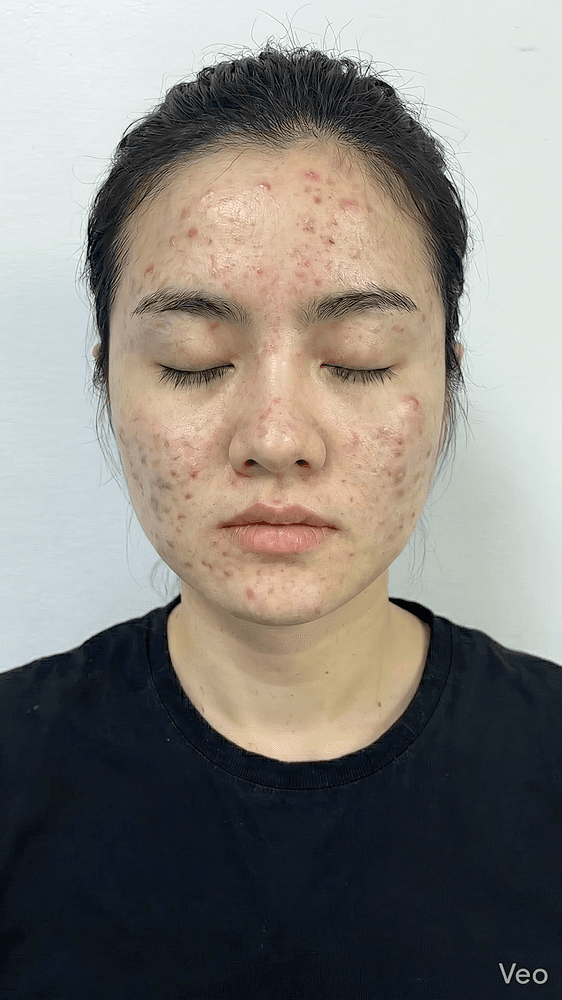 Hình minh họa tình trạng da trước liệu trình phục hồi tại ARIN