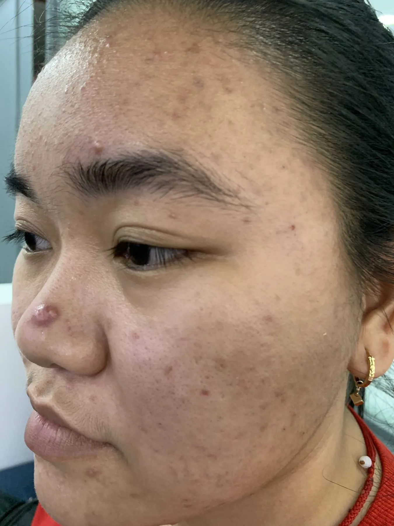 Hình ảnh làn da trước liệu trình tại ARIN