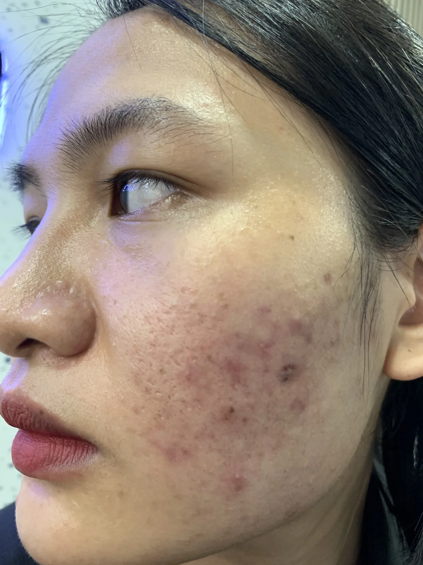 Hình ảnh làn da trước liệu trình tại ARIN