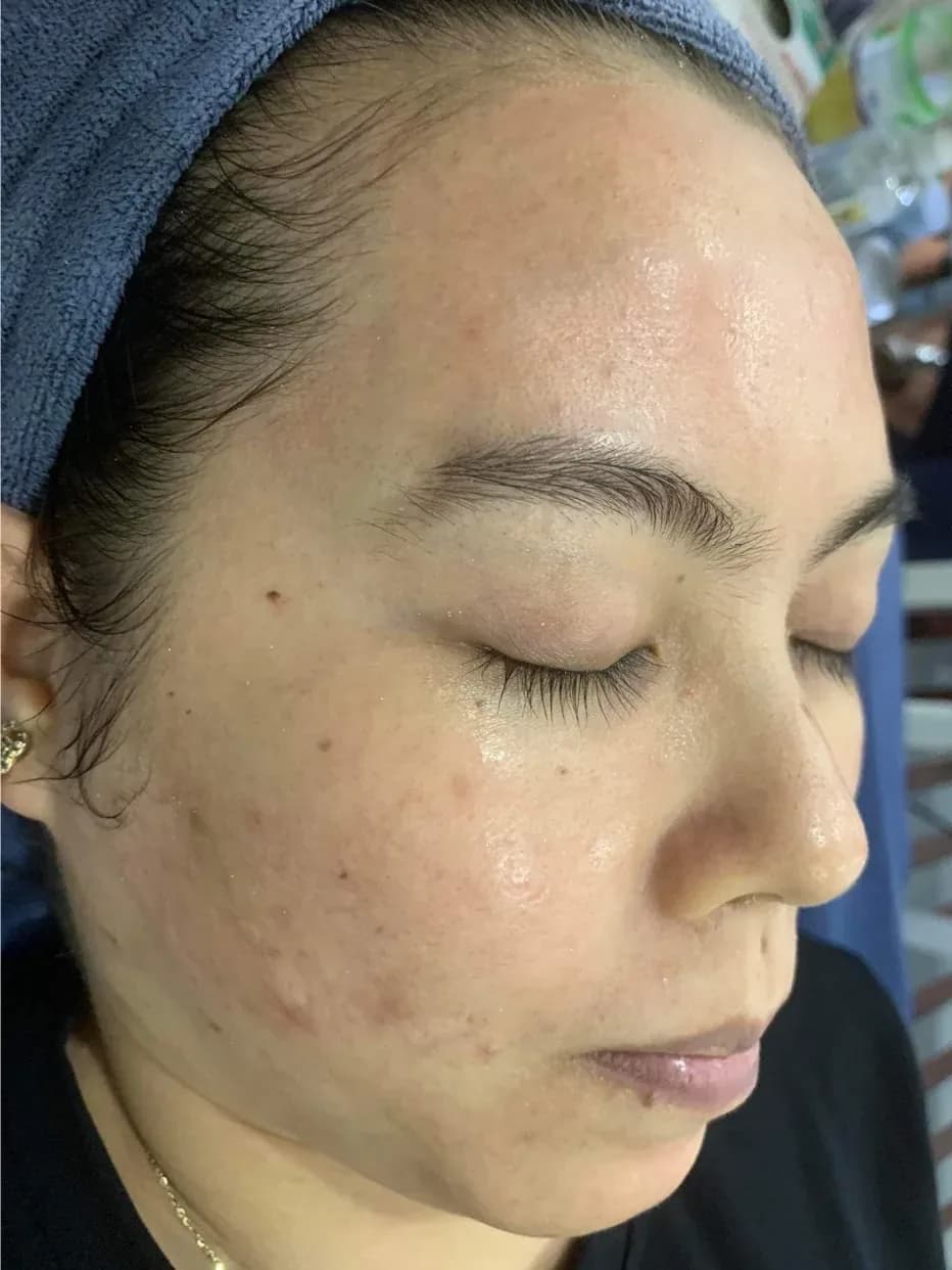 Hình ảnh làn da sau liệu trình tại ARIN